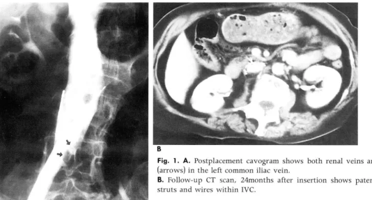 Fig.  1.  A.  Postplacement  cavogram  shows  both  renal  veins  and  thrombus  (arrows)  in  the left  common  iliac  vein
