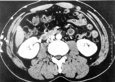Fig.  3.  Magnified  venogram  shows  prolapse  of  filter  wires(arrow)  above  anc horing  struts  in  the  Bird ’ s  Nest  filte r