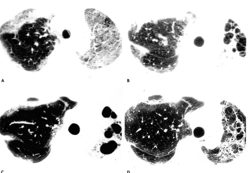 Fig.  1.  A.  HRCT  scan  obtained  7days  after  Paraquat  intake  at  the  1eve1  of  aortic  arch  shows  patchy  areas  of  ground -g1ass  opacity  in  both  1ungs
