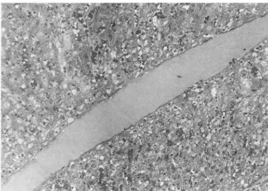 Fig .  4.  Histopathologic  specimen  obtained  after  electro- electro-cautery  of puncture tract( X 100)