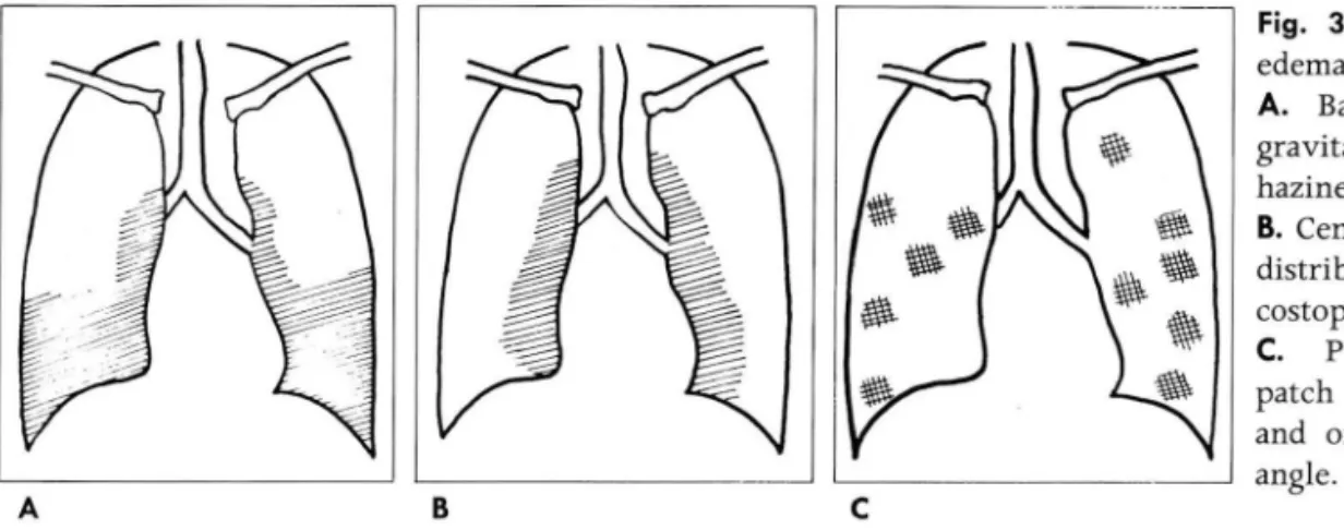 Fig.  3.  Distribution  of  pulmonary  edema 