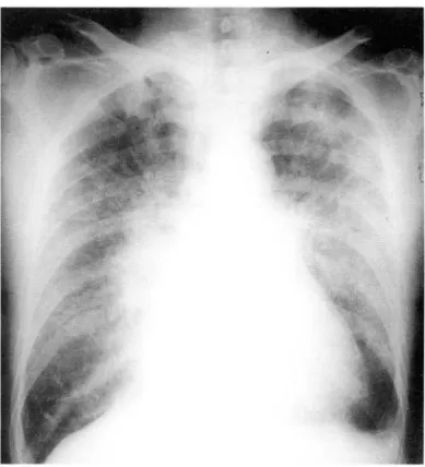 Fig.  S.  28-year-이 d  man  with  chronic  renal  failure  show- show-ing  pulmonary  ed ema
