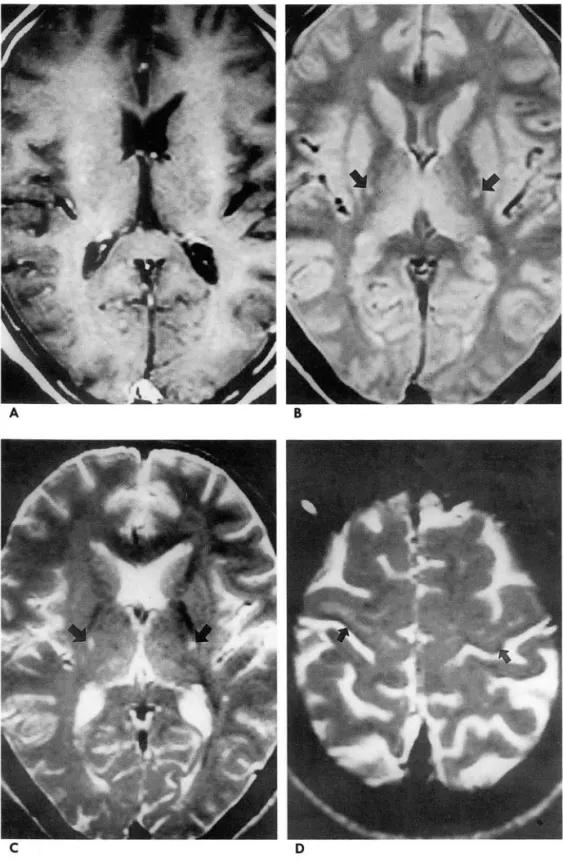 Fig.  1.  MR  Images  in  a  58-year-old  woman  with  a  2-year  history  of  progressive  motor  weakness  in  the  upper  extremities,  which  had   pro-gressed  to  generalized  weakness ,  and  dysarthria