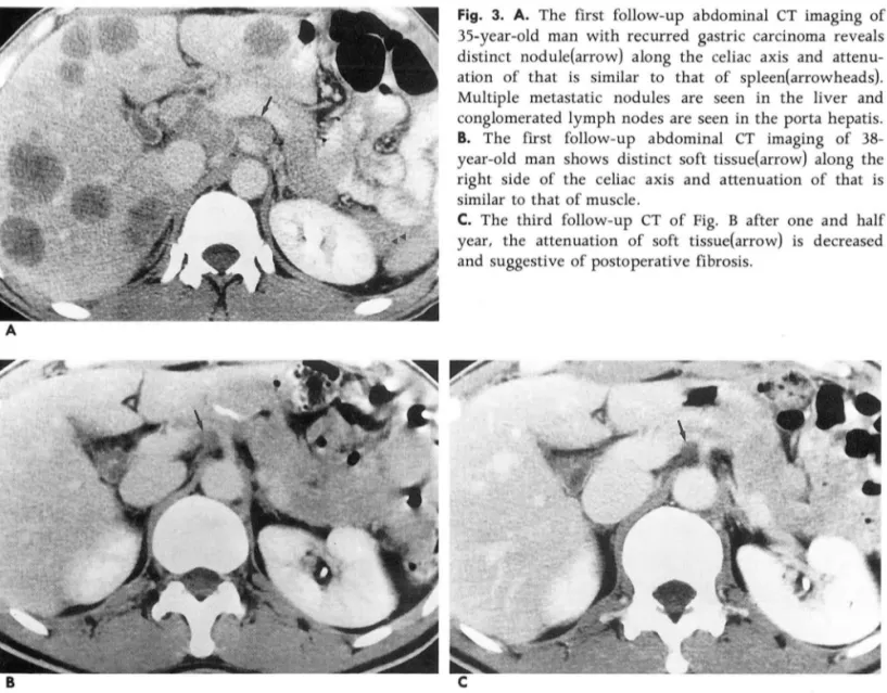 Fig.  3.  A.  The  first  follow-up  abdominal  CT  imaging  of  35-year-old  man  with  recurred  gastric  carcinoma  reveals  distinct  nodule(arrow)  a long  the  celiac  axis  and   attenu-ation  of  that  is  similar  to  that  of  spleen(arrowheads)