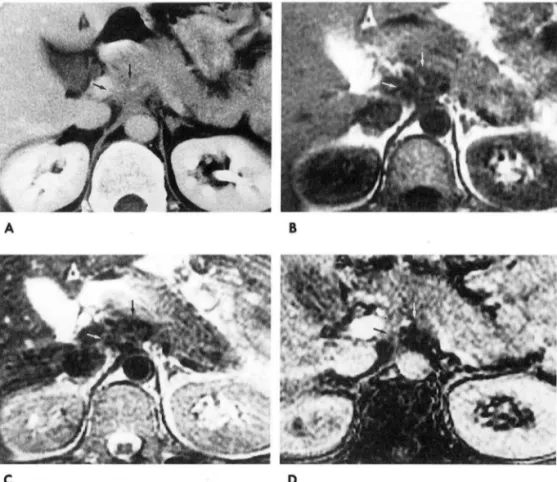 Fig.  4.  49-year-old  man with no  re- re-currence  of gastric  carcinoma  A.  The  first  follow  up  CT  shows  distinct  nodular  soft  tissue(arrows)  obliterating  the  celiac  axis