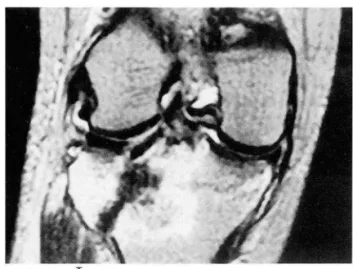 Fig.  1.  The  six  types  of tibial  plateau  fractures  according  to  the  Schatzker  classification