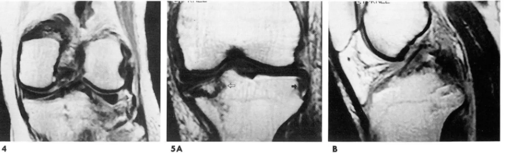 Fig.  4.  Type  m  fracture. 