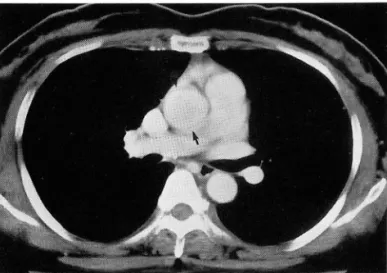 Fig.  2.  Contrast  enhanced  CT  irnage  at level  of right  main  pulmonary  artery  shows  symmetric  artifacts  in  left  an~ 