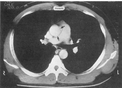 Fig.  8.  Contrast  enhanced  CT  scan  shows  circumferentia! 