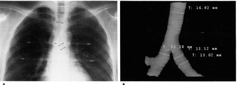 Fig.  1.  Methods  for  measurement of inner diameter of the  trachea  and  both  main  bronch i