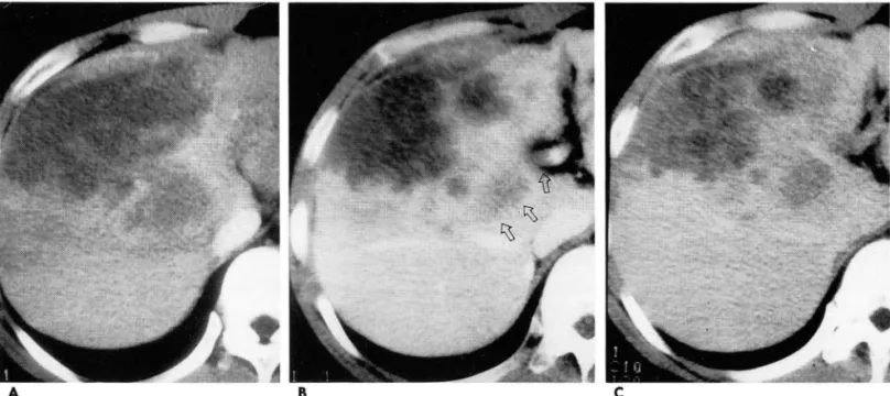 Fig.  1.  Low /l ow /l ow attenuation pattern  in  massive  hepatocellular carcinoma  with portal  vein thrombosis 