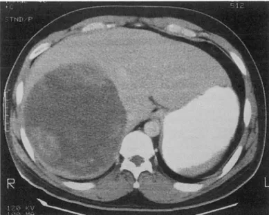 Fig.  1.  Postcontrast  CT  scan  shows  a  large ,  well  defined  mass  with  irregular  peripheral  enhancement  in  the  right  lobe  of the  live r