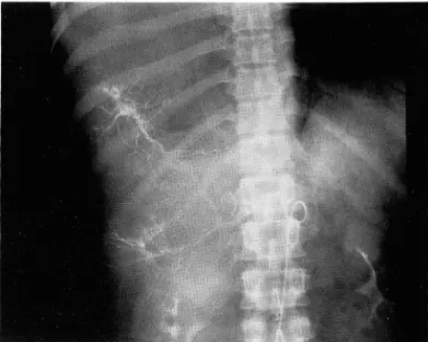 Fig.  3.  99mTc-RBC  scintigram  obtained  2hours  later  shows  persistently  increased  uptake  in  peripheral  portion  of the mass