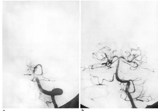 Fig.  3.  Filty-eight-year-old  man  wi th  4- 4-hour  duration  01  progressive  brain  stem  dyslunction 