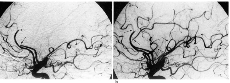 Fig.  6.  Sixty-three-year-이 d  woman  with  4-hour  duration  of  right  hemiparesis ,  facial  palsy  and  severe  aphasia 