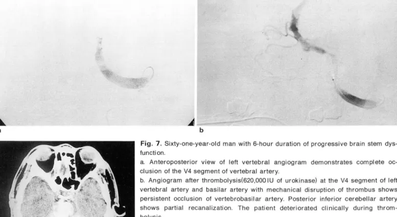 Fig.  7.  Sixty.one.year-old  man  with  6-hour  duration  of progressive  brain  stem  dys- dys-function 