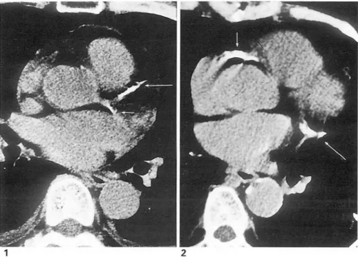 Fig . 1.  Spi ral  CT  scan  shows  calcificati on  in  left anterior  descending  artery(large   ar-row)  and  initiating  portion  of  the   circum-flex  artery(small  arrow) 