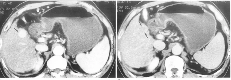Fig . 5. A 1.8-cm diameter  hepatocellular  carcinoma in  a  62  year-old-m an  with  li ver cirrhosis 