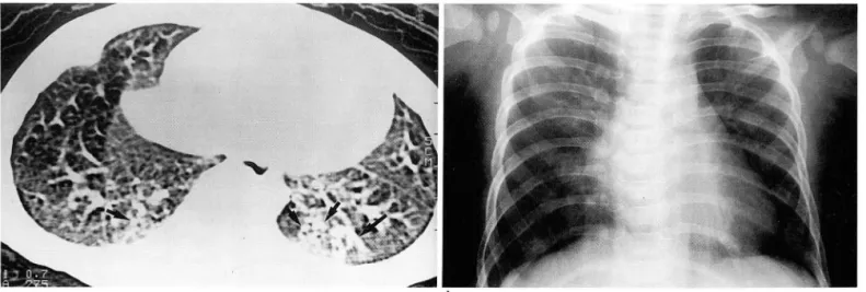 Fig.  3.  a.  HRCT  scan  of 9-month-old  infant  shows  multiple centrilobu lar  nodules(short  arrows)  in  posterobasal  segment  of  both  lower lobes  and  parenchymal  band  in  left  lower lobe(long  arrow) 