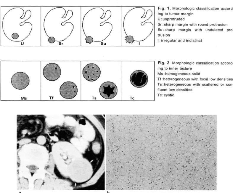 Fig.  1.  Morphologic classification  accord- accord-ing  to  tumor  margin 
