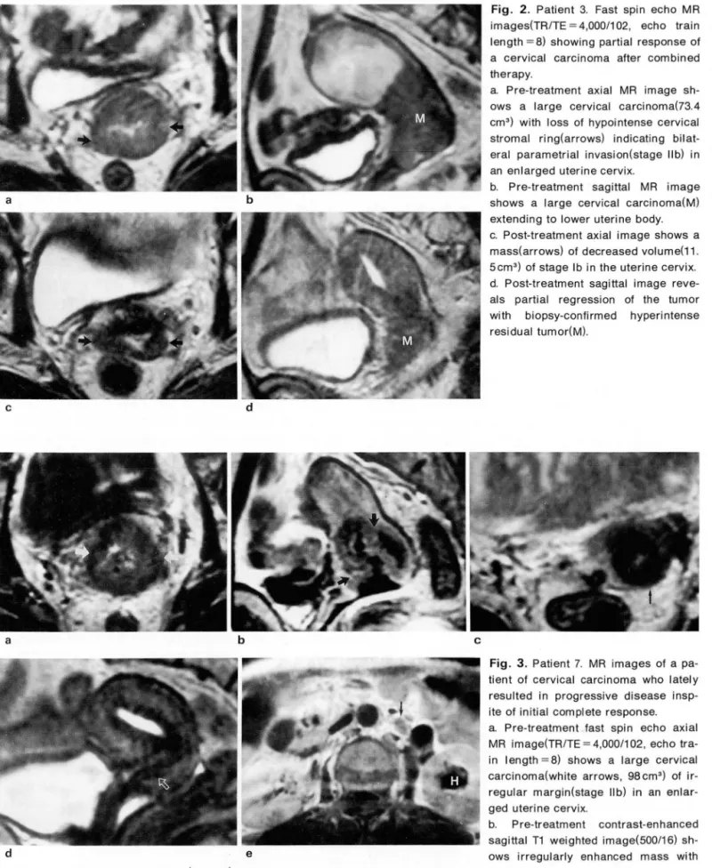 Fig.  2 .  Patient  3.  Fast  spin  echo  MR  images(TR/TE =  4 , 000/1  02 ,  echo  train  length = 8)  showing  partial  response  of  a  cervical  carcinoma  after  combined  therapy 