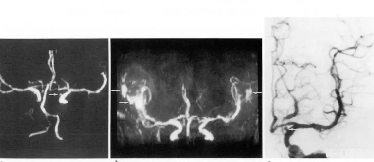 Fig.  1. Images 01  a  74-year-old  woman  with  a  small  aneurysm  01  the  left  internal  carotid  artery  not  seen  on  MR  angiogram  a
