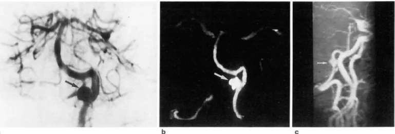Fig.  2.  Images  01  a  56-year-old  man  with  a  vertebra l artery  aneurysm  with  calcilication 