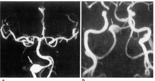 Fig.  4 .  Images  of  a  47-year-old  woman  with  a  large  fus iform  vertebral  artery   an-eurysm  better seen  on  CTA  than  MR A
