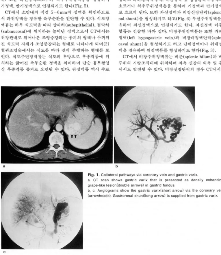 Fig . 1. Collateral  pathways  via  coronary vein  and  gastric  varix 