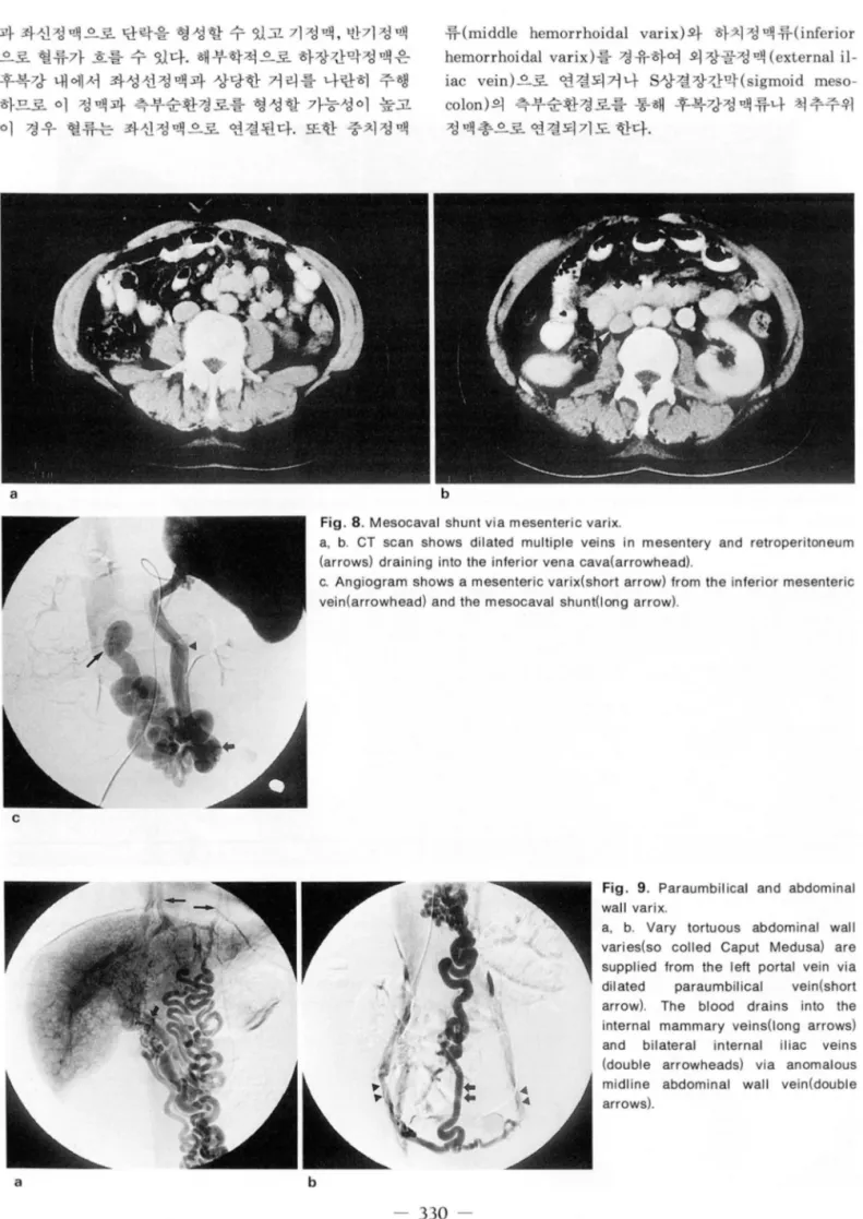 Fig.  8.  Mesocaval  shunt via mesenteric varix 