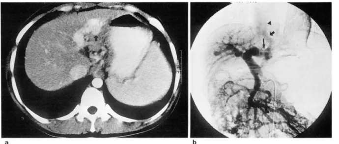 Fig .  10. Intrahepatic collateral pathway ‘ 