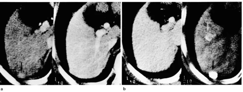 Fig.  1.  High-Iso-Iso  attenuation  (smaller than  20  mm) . 
