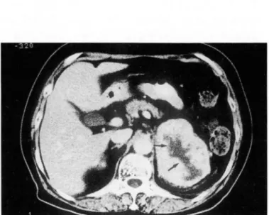 Fig.  1.  A  benign  pheochromocytoma  in  right  adrenal  gland.  A  Fig .  2.  A  large  carcinoma  in  left  adrenal  gland