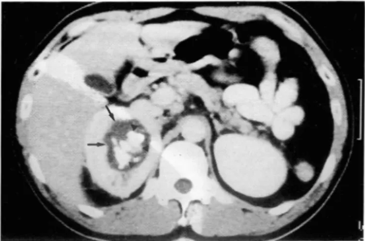 Fig.  3.  Pheochromocytoma  with  smooth ,  round  intratumoral  hypoden sity(arrows)  and  calcifications(arrowheads)  is  noted  in  right  adrenal  gland 