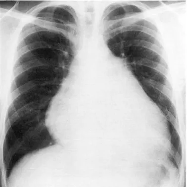 Fig .  1 .  Chest  radiograph  shows  cardiomegaly  w ith  saggi ng  appearance and  small  amount  01  left  p leural ellusion 
