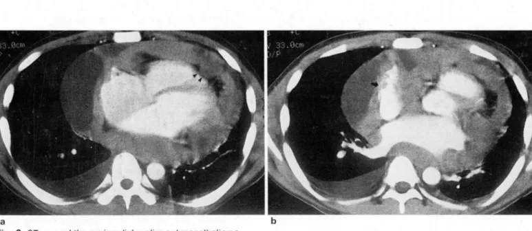 Fig.  2.  CT  scan  o f.t he  pericardial  malignant mesothelioma 