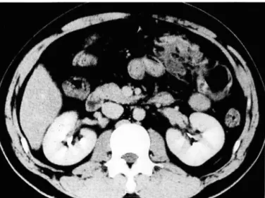 Fig.  1 .  Contrast-enhanced  CT  scan  shows  segmental  bowel  wall  thickening  with  intramural  hematoma  and  focal   mesen-teric  infiltration  of  the  transverse  colon 