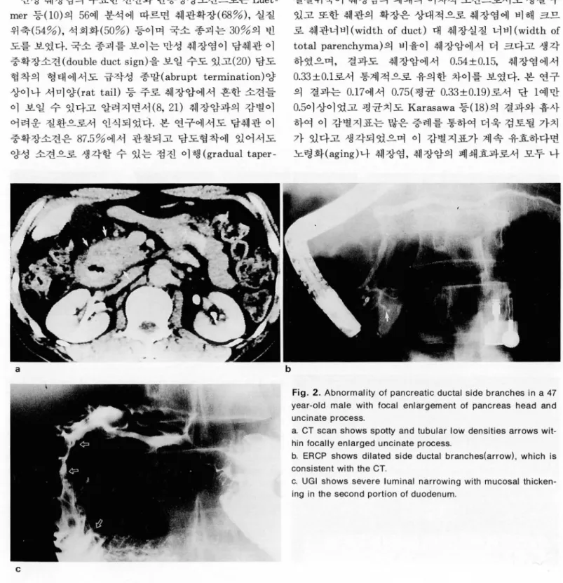 Fig.  2.  Abnormality  01  pancreatic  ductal  side  branches in  a  47 