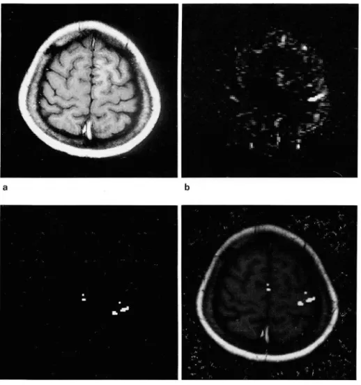 Fig.  2.  Functional  imaging  of  the  motor  cortex  activated  by  right finger movement  a