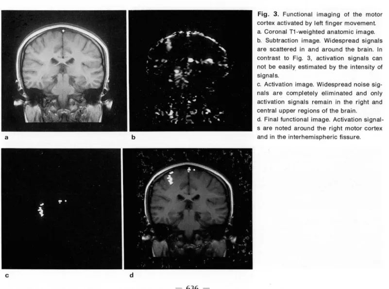 Fig.  3.  Functional  imaging  01  the  motor  cortex activated  by  left linger movement  a