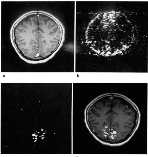 Fig.  4.  Functional  imaging  01  the  visual  cortex  activated  by  photic  stimulation  a