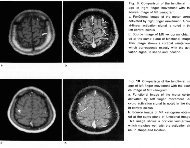 Fig.  9.  Comparison  of  the  functional  im- im-age  of  right  finger  movement  with  the  source  image  of  MR  venogram 
