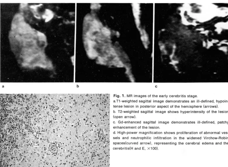 Fig.  1. MR  images  of the early cerebritis  stage 