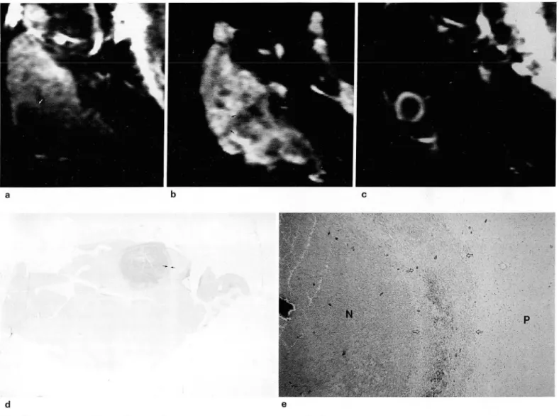 Fig.  3.  MR  images  of the early capsular stage 