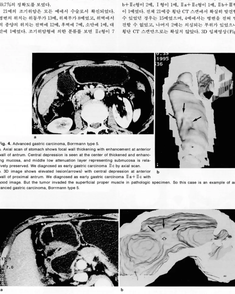Fig.  4.  Advanced  gastric  carcinoma ,  Borrmann  type  5 