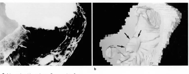 Fig.  8.  Advanced  gastric  carcinoma ,  Borrmann type 3 