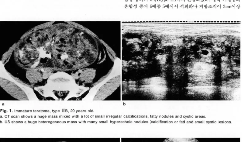 Fig .  1. Immature teratoma, type  ills , 20  years  old. 