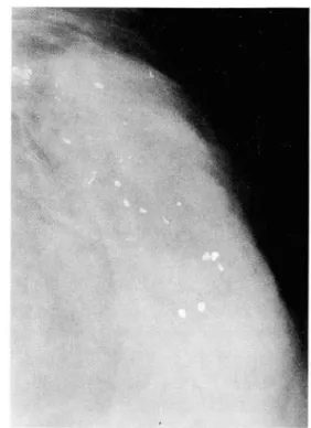 Fig.  1. Intraductal  carcinoma 