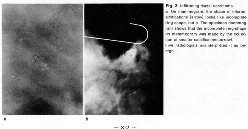 Fig.  3.  Inliltrating  ductal  carcinoma. 