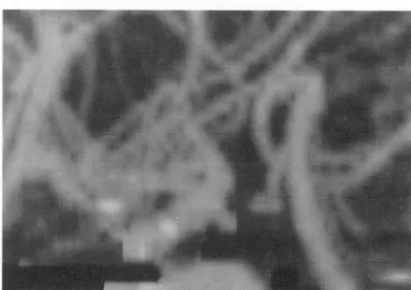 Table 1.  Artifacts  on  CT Angiography 